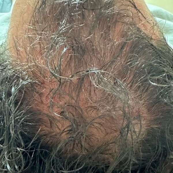 Patient's crown before treatment, with diffuse thinning and visible scalp