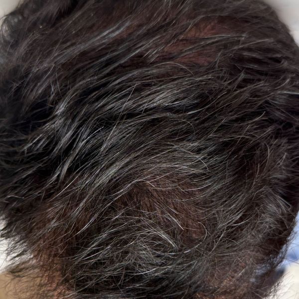 The same patient's mid-scalp after treatment, with thicker coverage