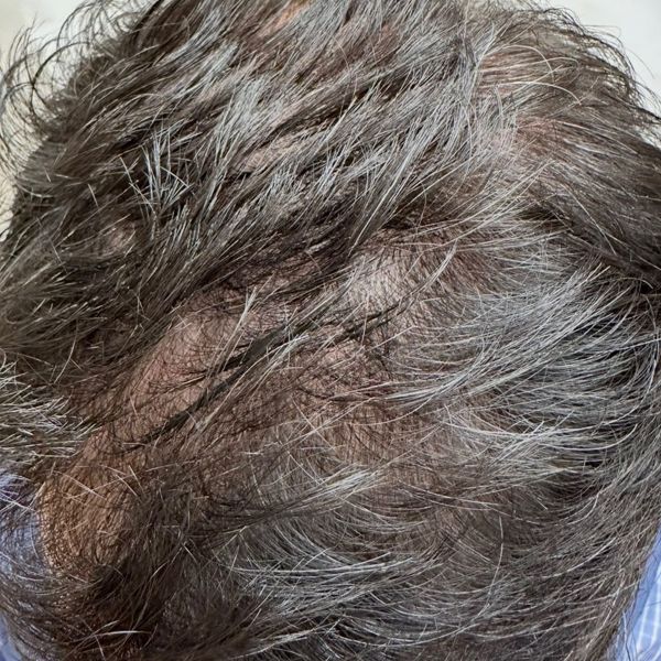 Patient's mid-scalp before treatment, with scalp showing through the hair