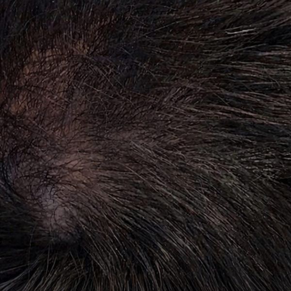 The same patient's vertex after treatment, filled in with regrowth