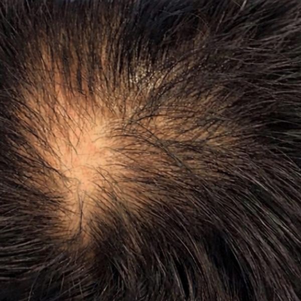 Patient's vertex before treatment, with an open thinning spot