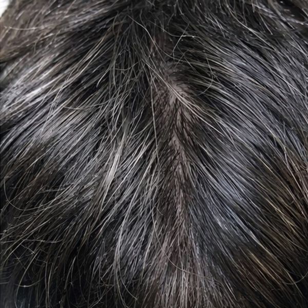 The same patient's part line after treatment, narrowed by new density