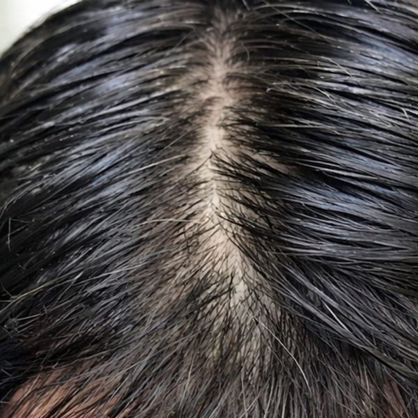 Patient's part line before treatment, widened with visible scalp