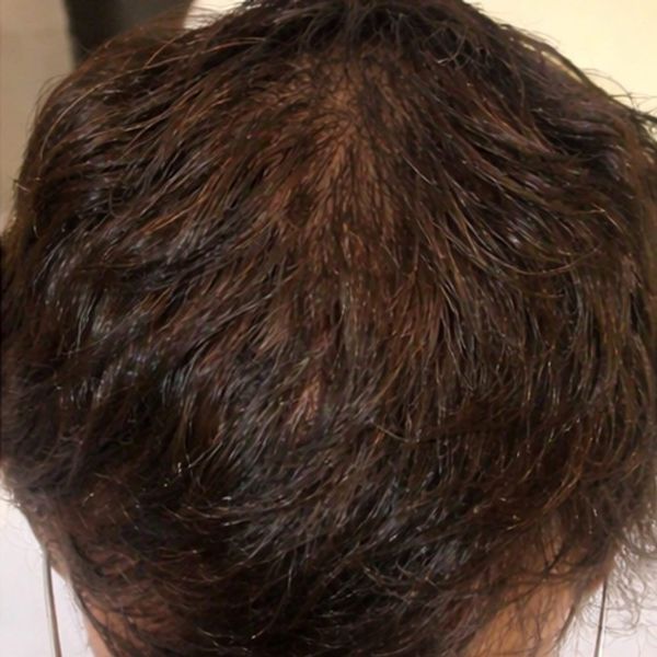 The same patient's upper crown after treatment, with denser coverage