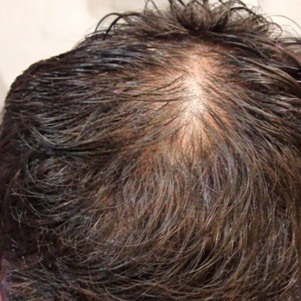Patient's upper crown before treatment, thinning around the whorl