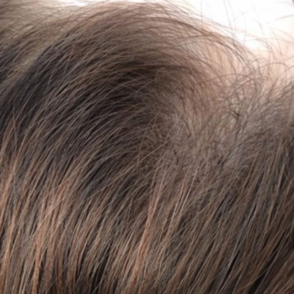The same patient's frontal scalp after treatment, with fuller coverage