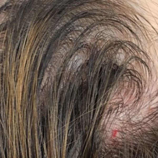 Patient's frontal scalp before treatment, sparse along the part